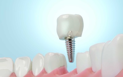 Acil Durumlarda Hızlı Çözüm: 1 Günde İmplant ve Kaplama