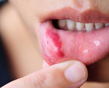 Mouth Sores and Their Treatment