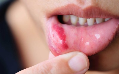Ağız Yaraları ve Tedavisi