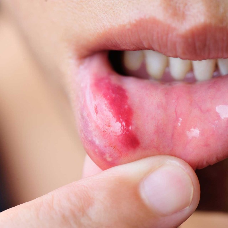 Mouth Sores and Their Treatment