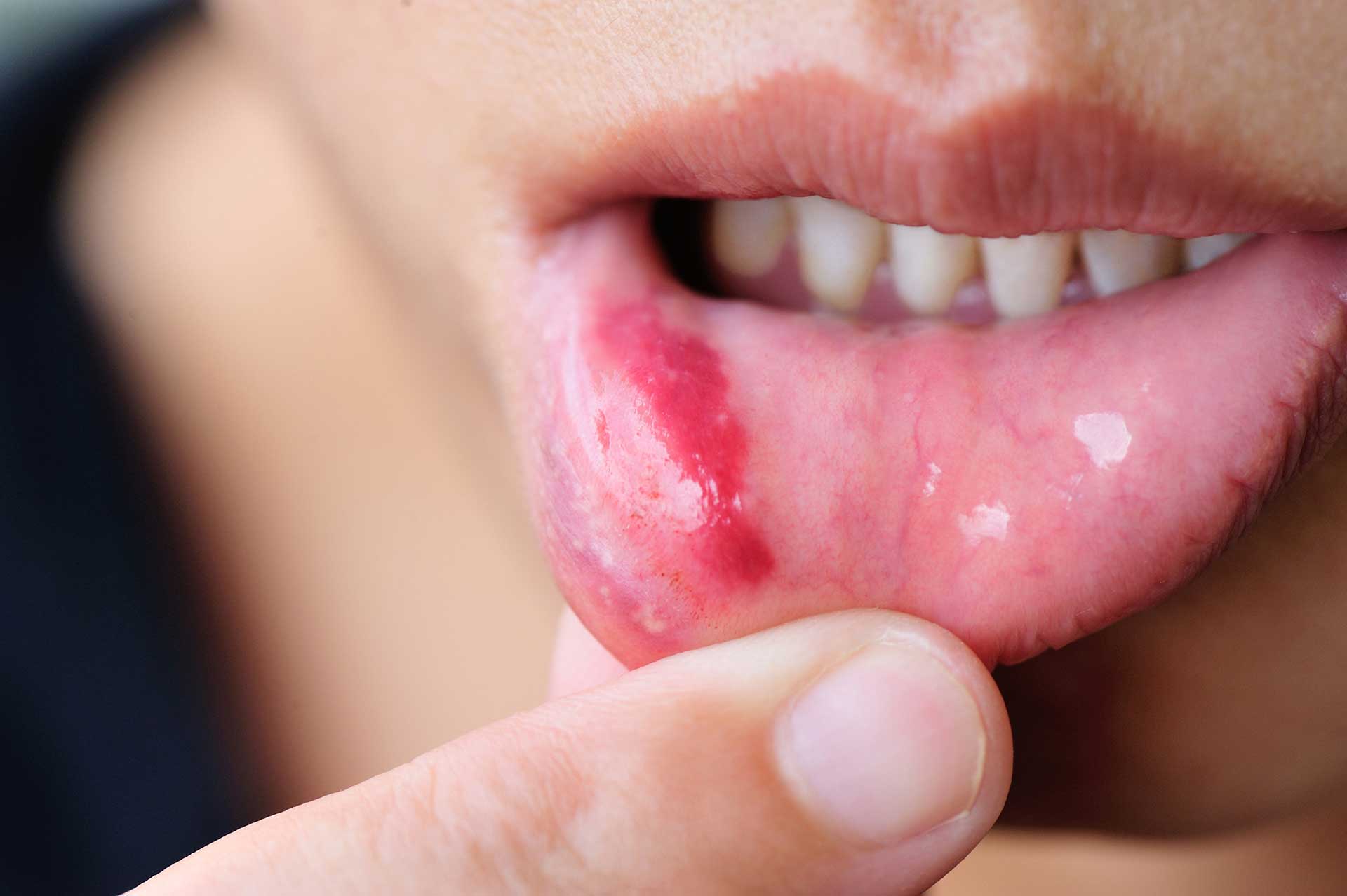 Mouth Sores and Their Treatment