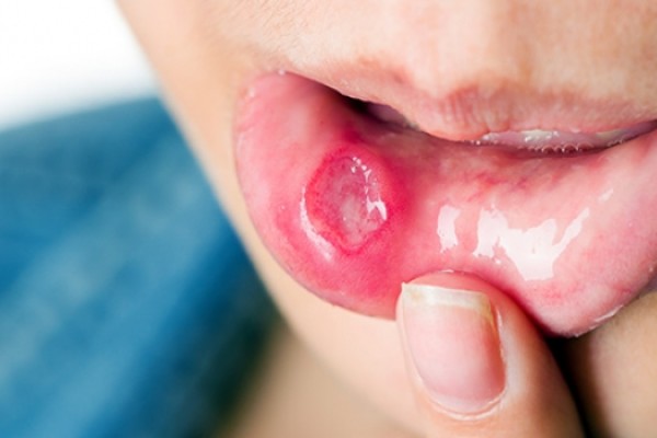 Ağız Yarası Nedir?