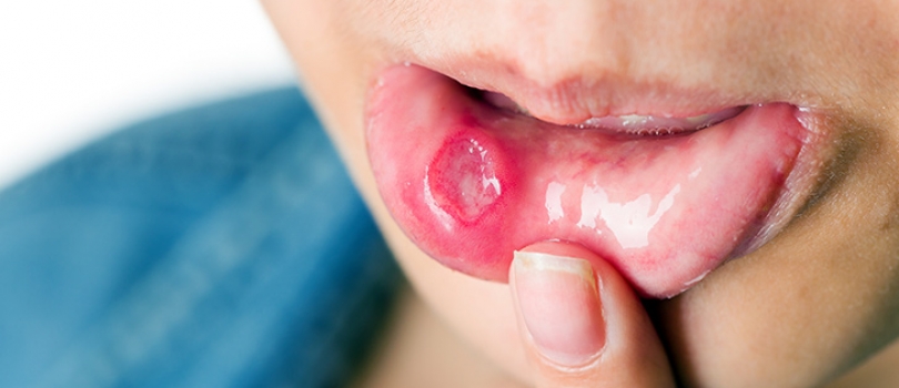 What Is a Mouth Sore?