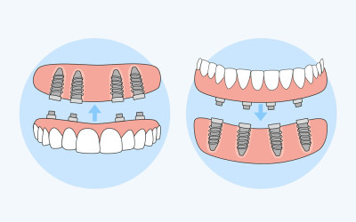 What You Need to Know About All On Four