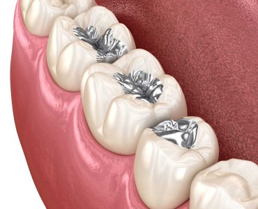 Amalgam Dolgu Nedir? Neden Artık Tercih Edilmiyor?