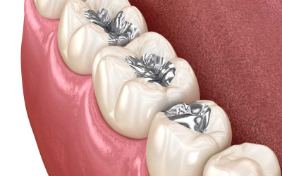 Amalgam Dolgu Nedir? Neden Artık Tercih Edilmiyor?