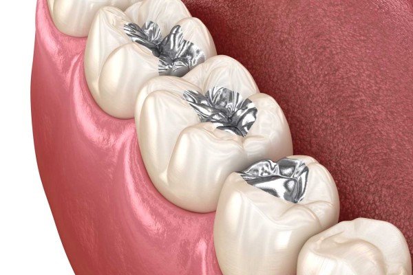 Amalgam Dolgu Nedir? Neden Artık Tercih Edilmiyor?