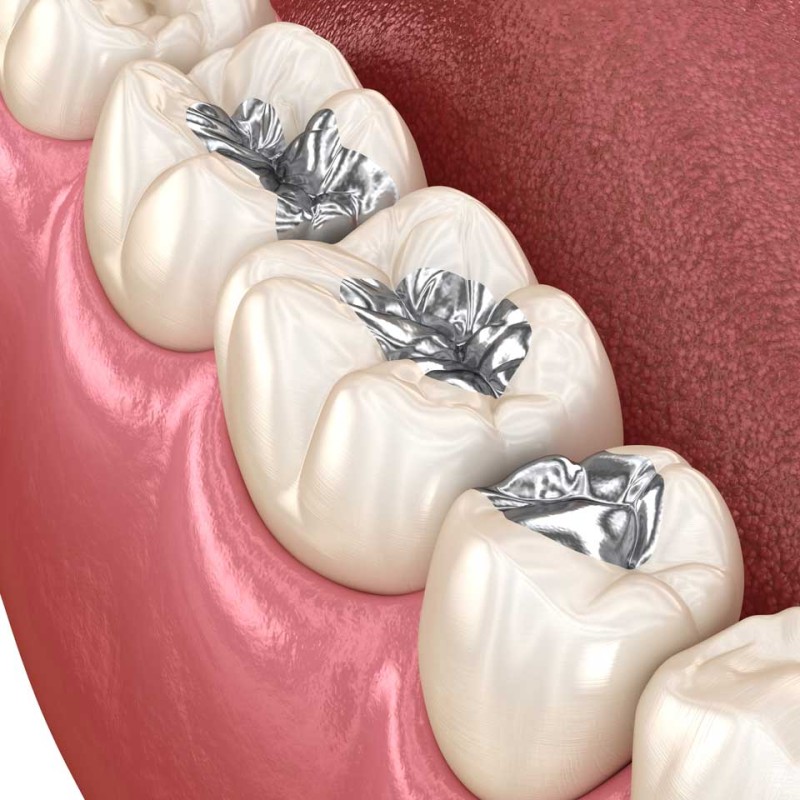 What is Amalgam Filling? Why Is It No Longer Preferred?