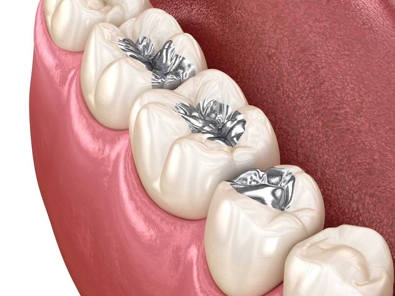 Amalgam Dolgu Nedir? Neden Artık Tercih Edilmiyor?