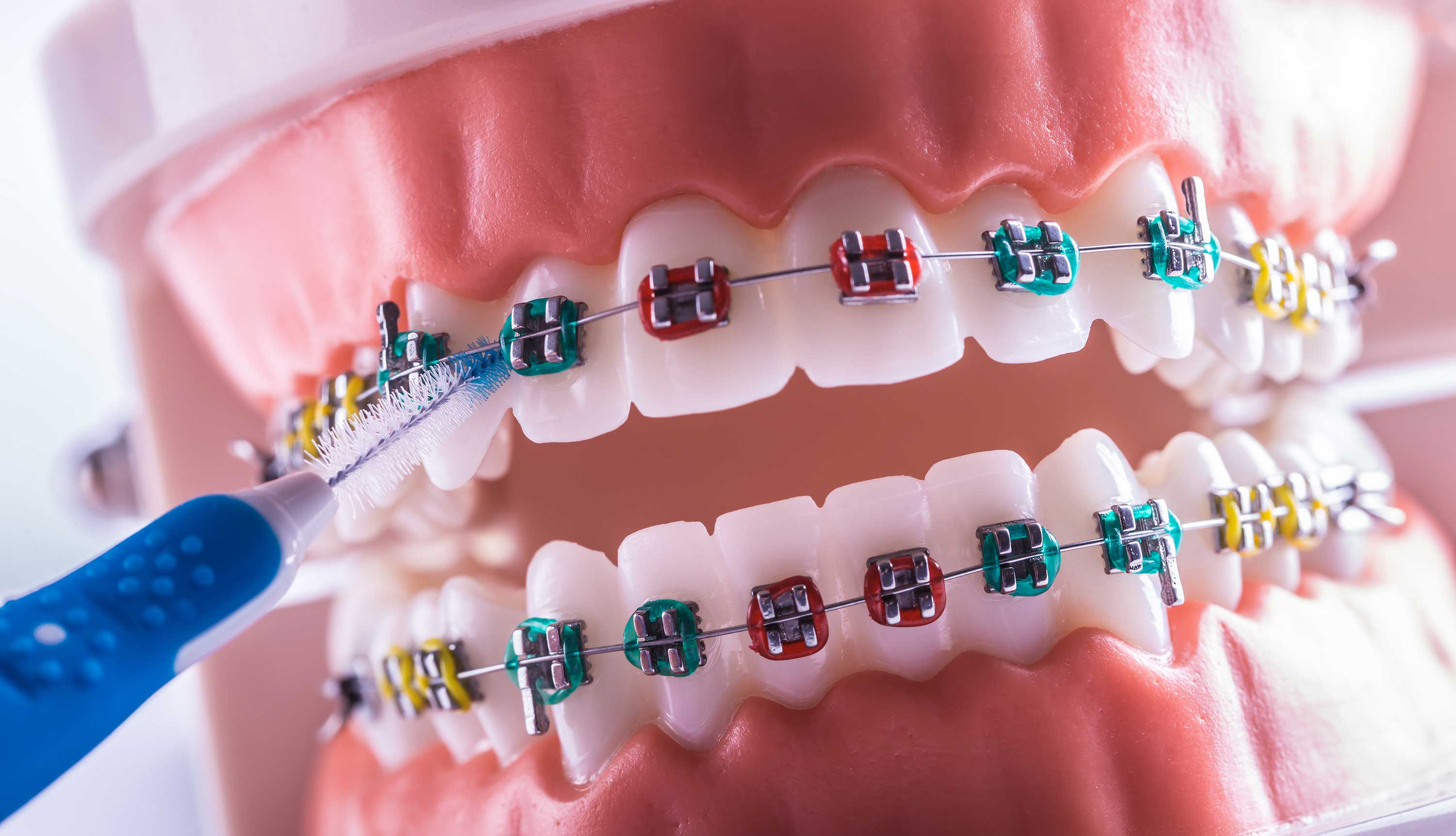 What is an Interface Brush? Comparison with Dental Floss
