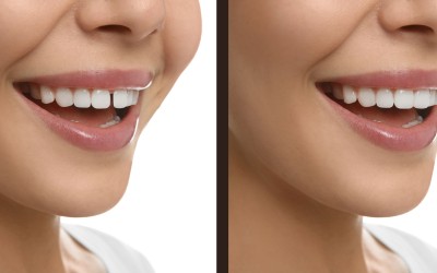 Ayrık Diş (Diastemalı Dişler) Tedavi Yöntemleri Nelerdir?