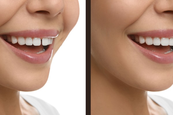 Ayrık Diş (Diastemalı Dişler) Tedavi Yöntemleri Nelerdir?