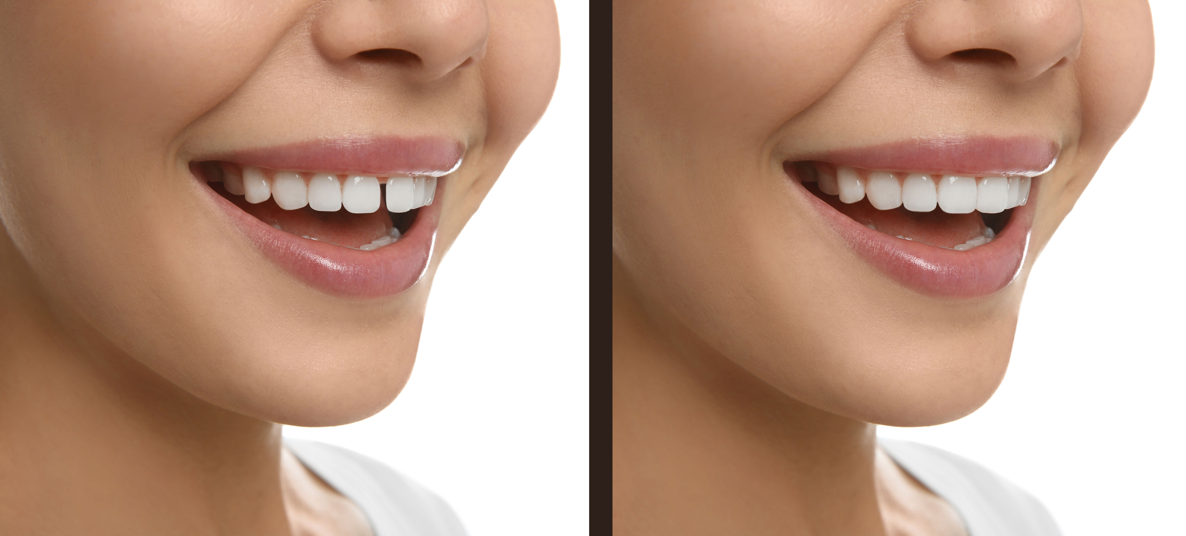 What are the Treatment Methods for Split Teeth (Diastema Treatment)? 