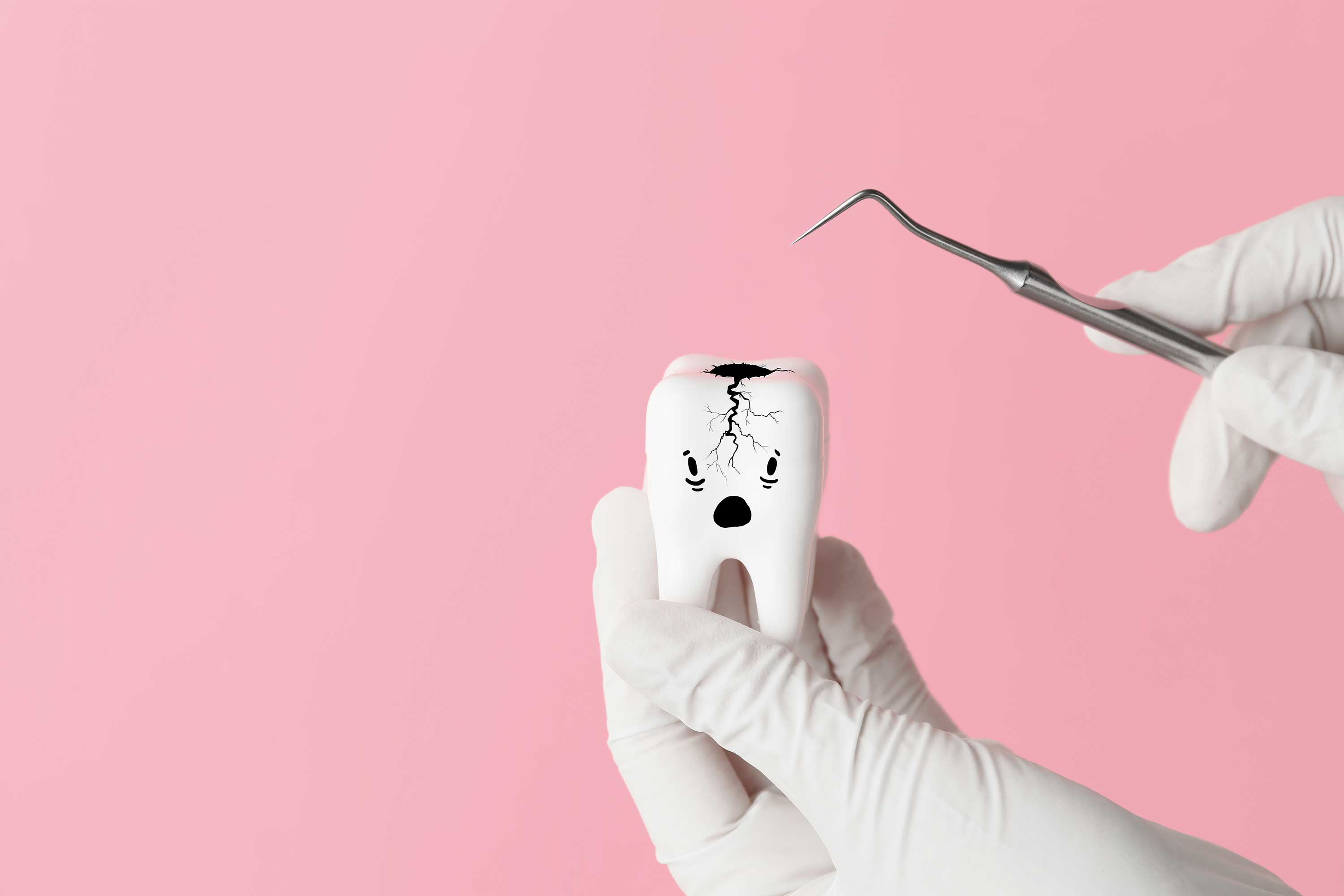 Cracked Tooth Syndrome