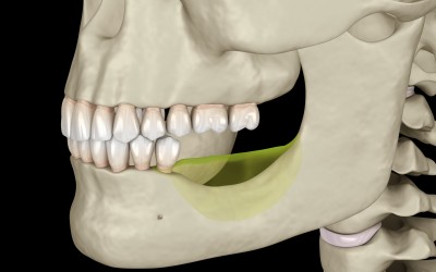 Çene Kemiği Erimesi Nedir? Belirtileri Nelerdir?