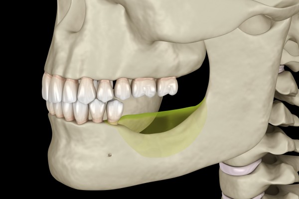 Çene Kemiği Erimesi Nedir? Belirtileri Nelerdir?