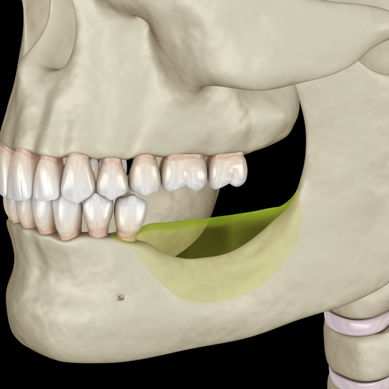 What is Jaw Bone Resorption? What are The Symptoms?