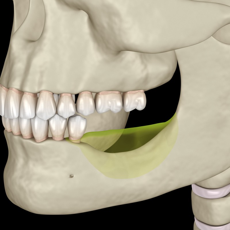 Çene Kemiği Erimesi Nedir? Belirtileri Nelerdir?