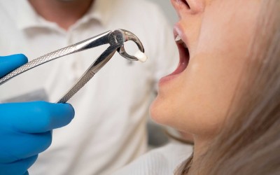 Cerrahi Diş Çekimi: Gerekçeler ve İyileşme Süreci