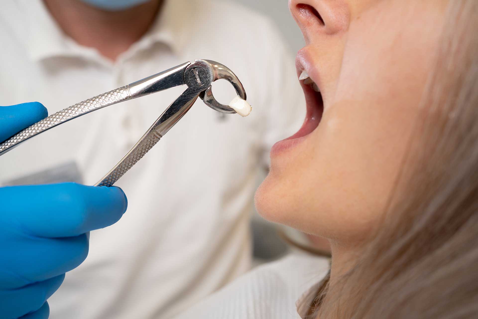 Surgical Tooth Extraction: Reasons and Recovery Process