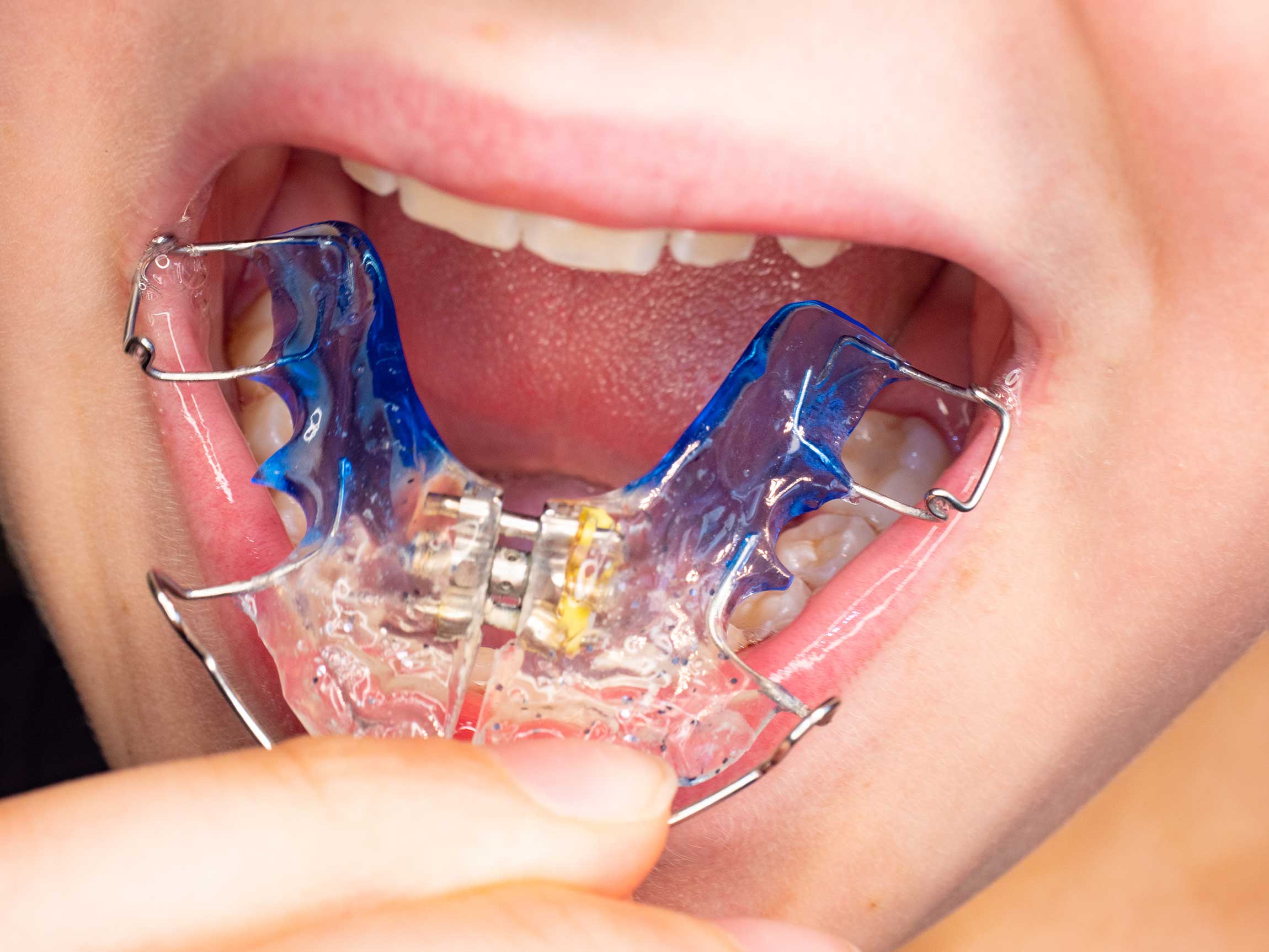 When is a Palate Used?