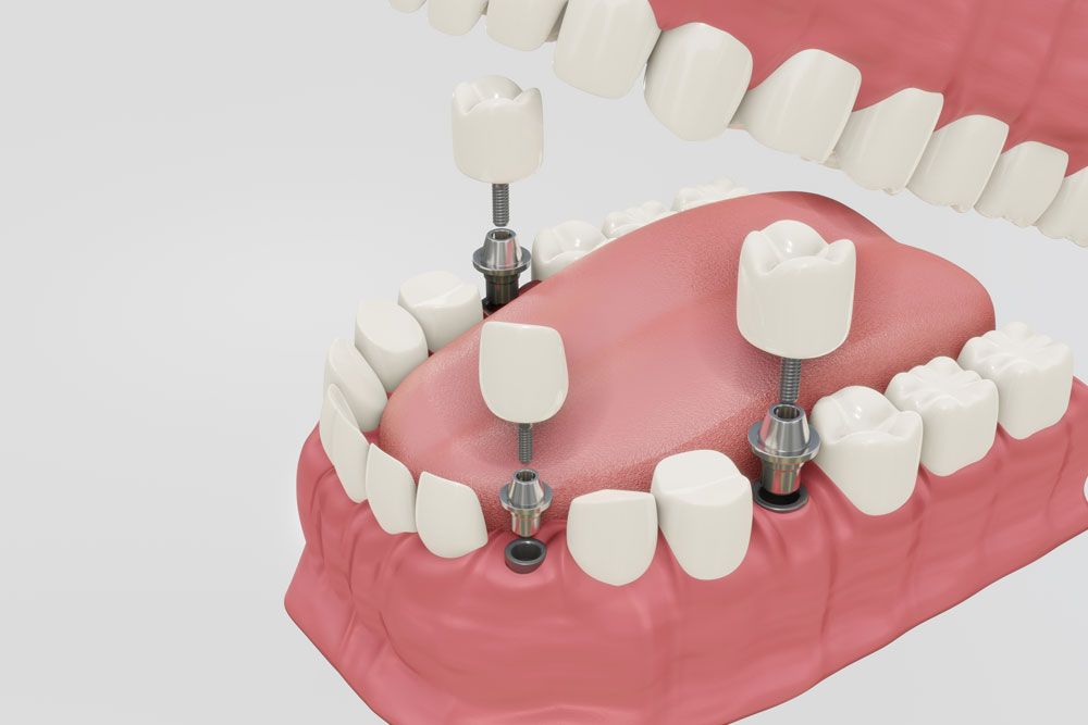 dental implant