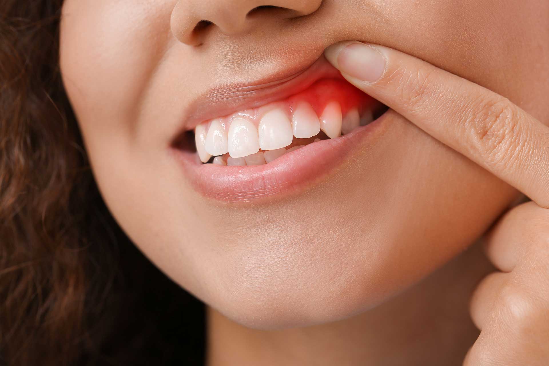 Tooth Abscess: Symptoms and Treatment