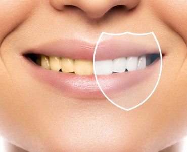 Dişleri Beyazlatmak İçin Yapılan 5 Hata