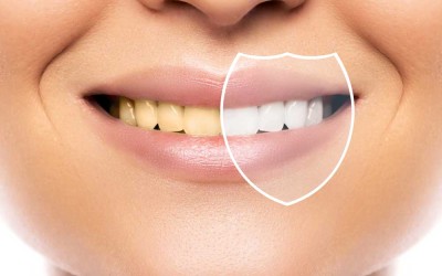 Dişleri Beyazlatmak İçin Yapılan 5 Hata