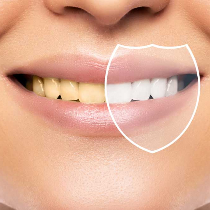 5 Mistakes For Whitening Teeth 