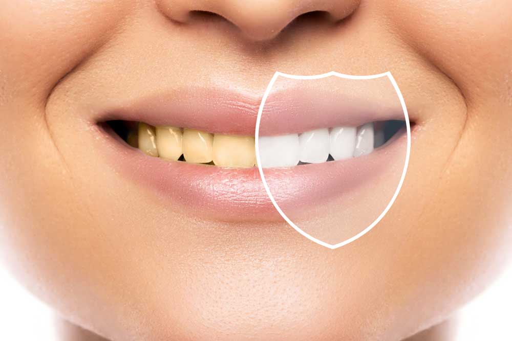5 Mistakes For Whitening Teeth 