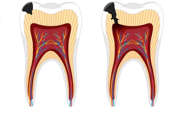 Diş Çürüğü Nedir? Nasıl Tedavi Edilir? 