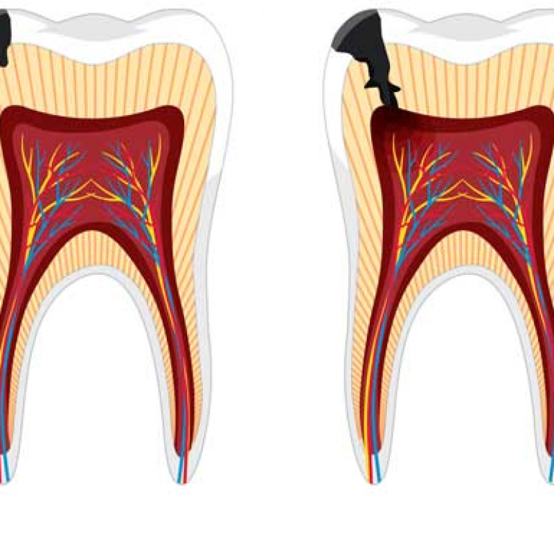 Diş Çürüğü Nedir? Nasıl Tedavi Edilir? 