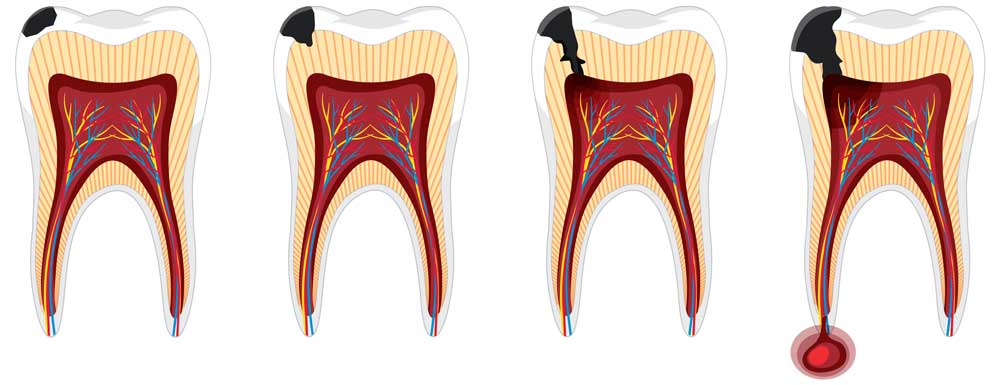 What Is Tooth Decay? How Is It Treated? 