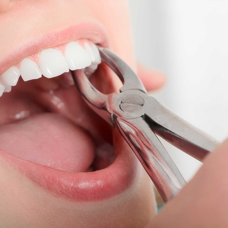 How Should You Eat After Tooth Extraction? What Should You Pay Attention to in General?