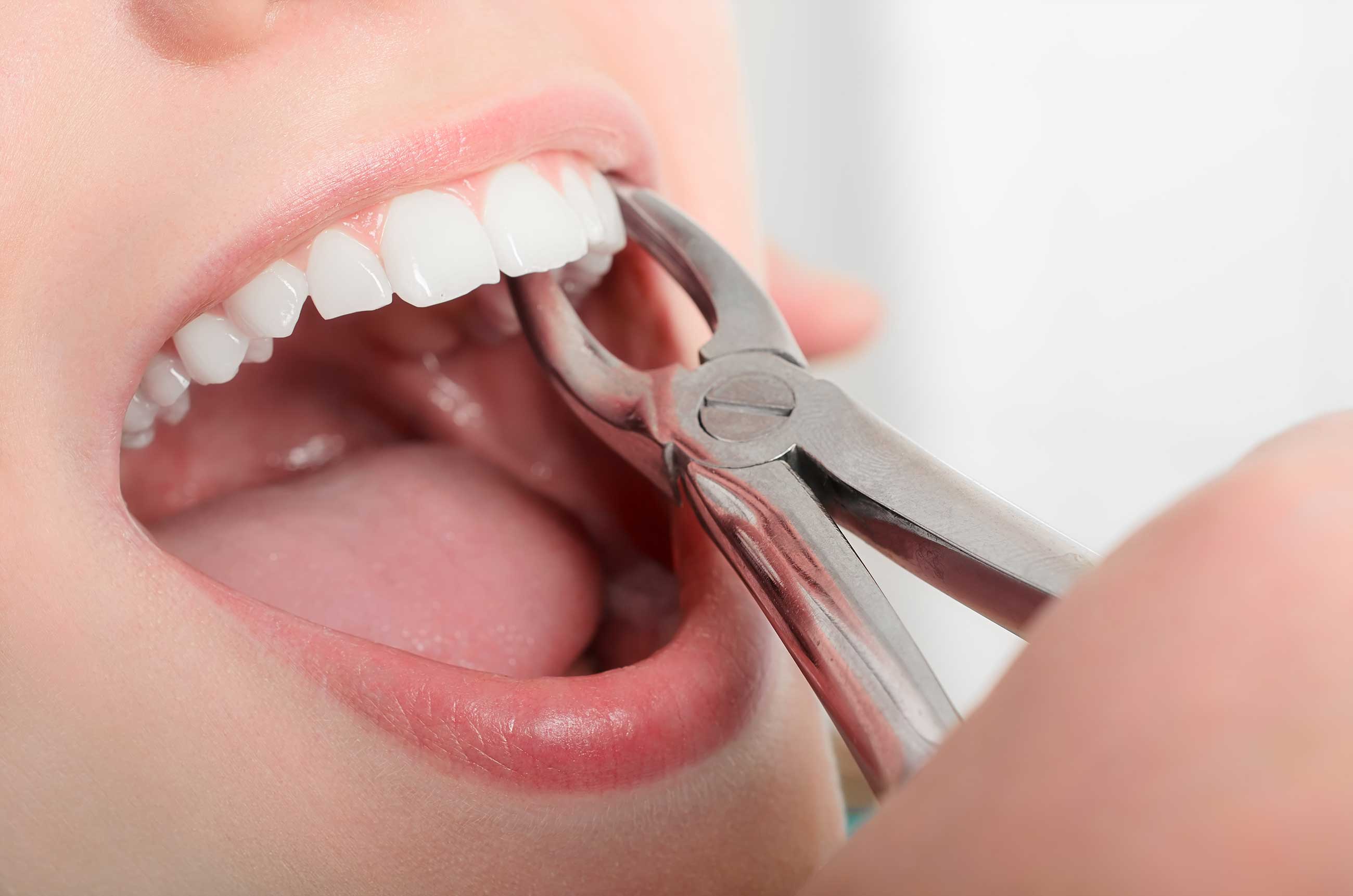 How Should You Eat After Tooth Extraction? What Should You Pay Attention to in General?