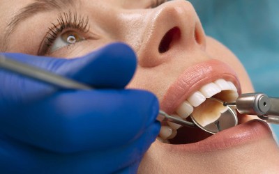 Diş Dolgusu Sonrası Bakım: Nelere Dikkat Etmelisiniz?