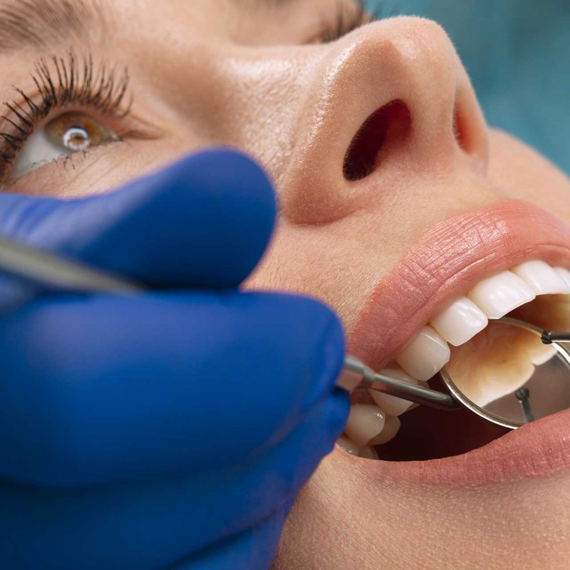 Caring for Your Dental Filling: Essential Tips for Post-Treatment Care