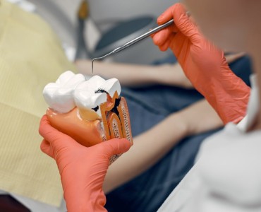 Things to Consider After a Dental Filling
