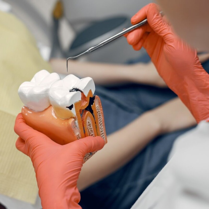 Things to Consider After a Dental Filling