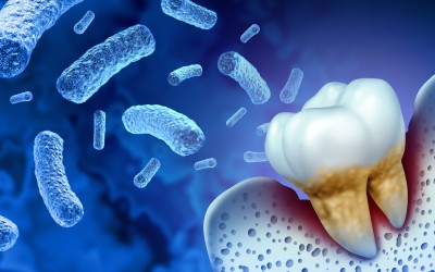 Diş Enfeksiyonu Belirtileri ve Tedavileri