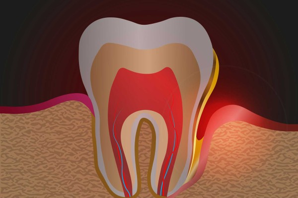 Diş Eti Cebi Nedir ve Tedavisi Nasıl Yapılır?