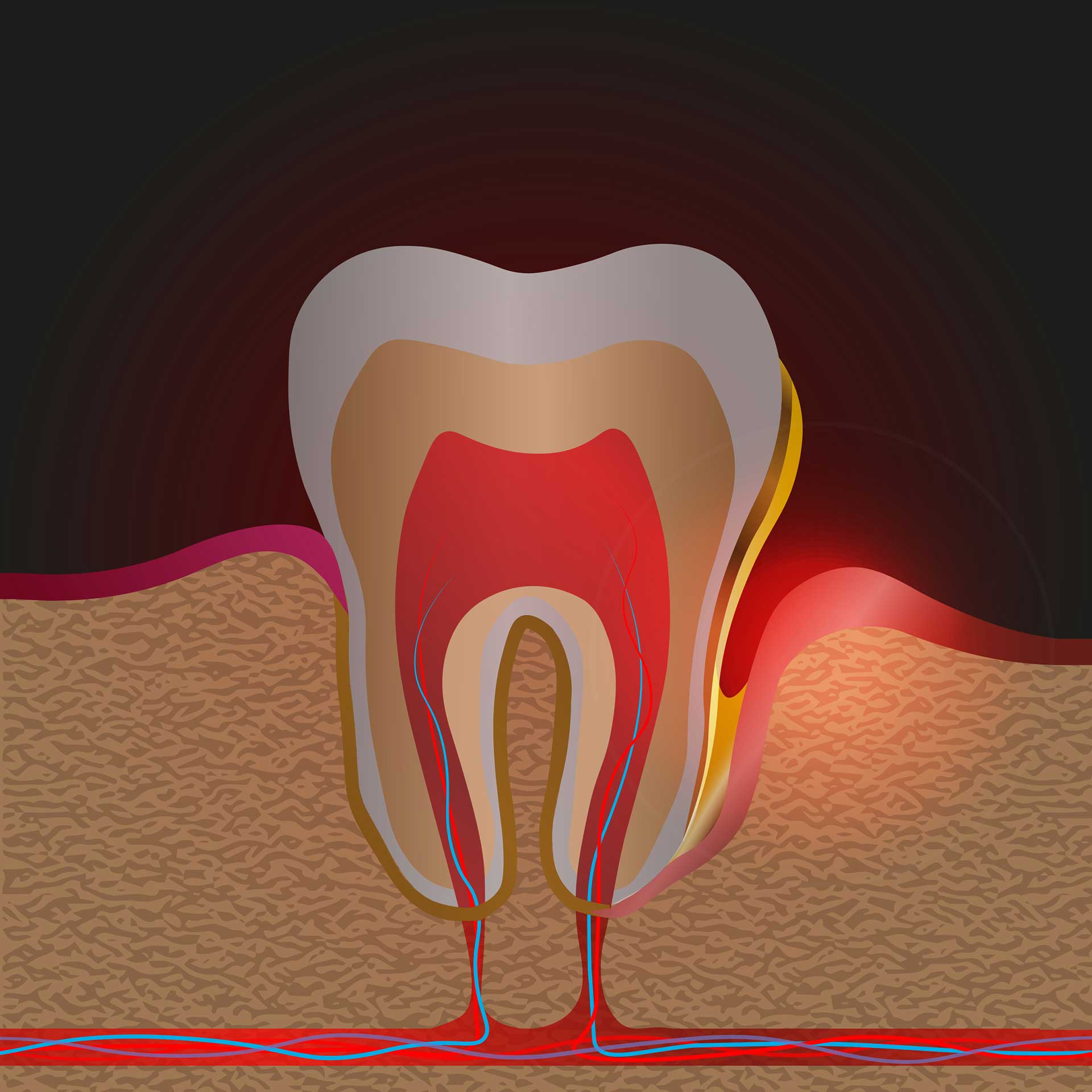 What is Gum Pocket and How Is It Treated?