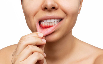 Diş Eti Çekilmesi Tedavisi