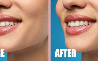 Gum Aesthetics for Healthier and More Beautiful Smiles