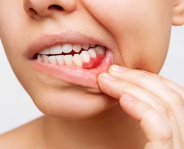 Diş Eti Hastalıkları ve Kalp Sağlığı Arasındaki Bağlantı Nedir?
