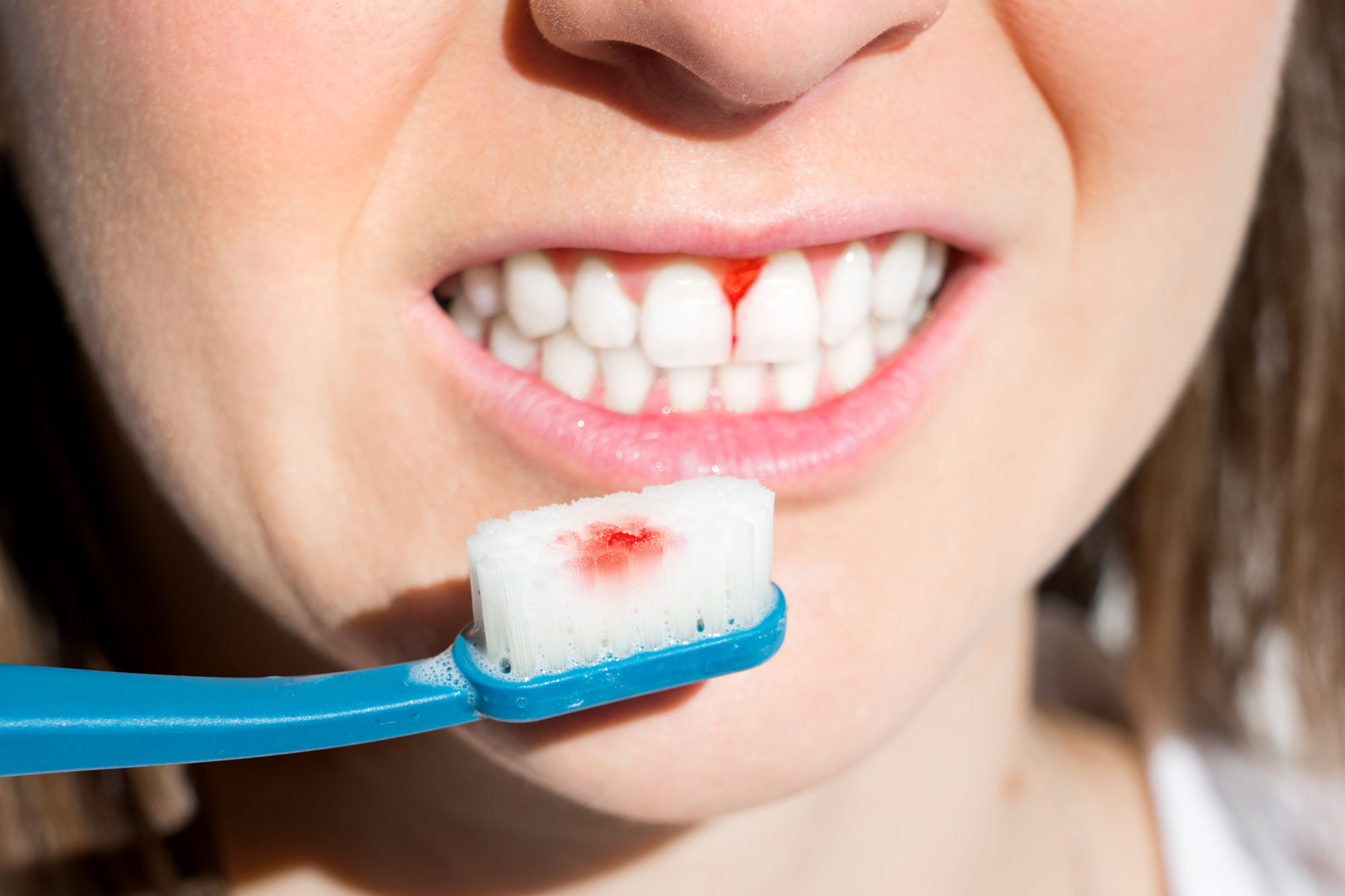 What Causes Gingival Bleeding? How does it pass? 