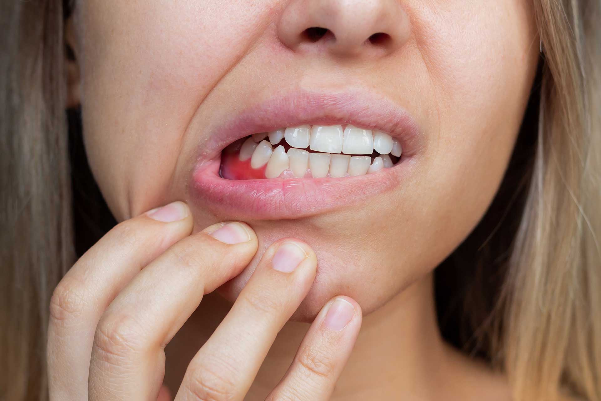 Bleeding Gums: Causes and Prevention