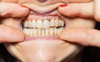 Diş Eti Çekilmesi Nedir?