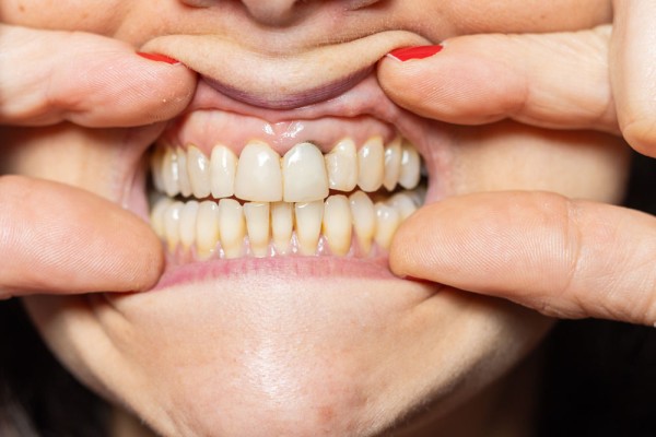 Diş Eti Çekilmesi Nedir?